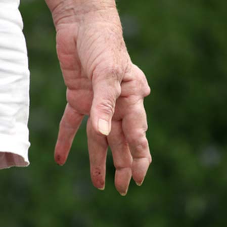 Integrative Medical Clinic Belleville NJ Arthritis Relief